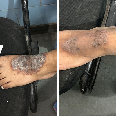Eczema